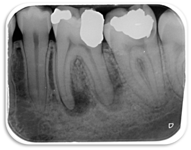 tooth abscess xray