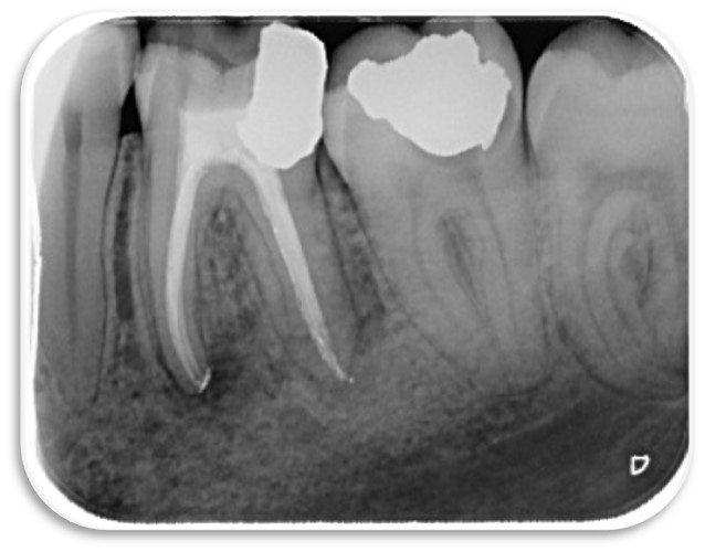 Root canal results