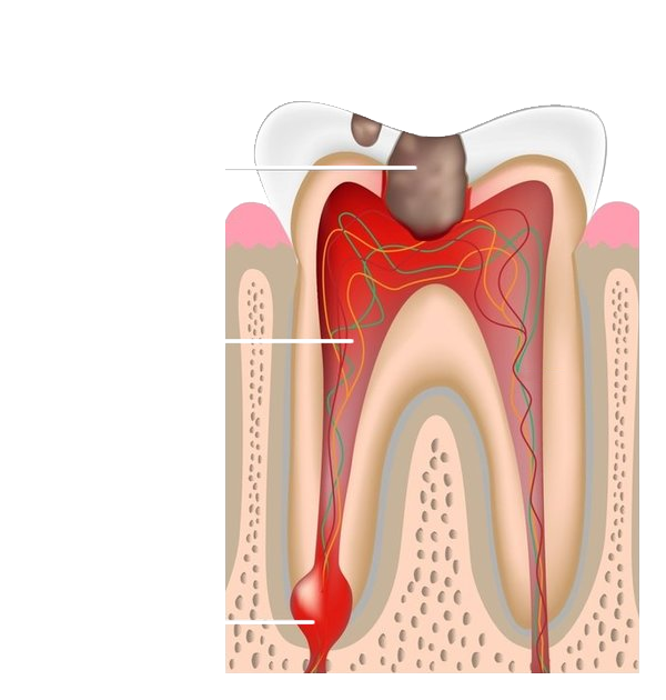 Endodontics Infected Tooth