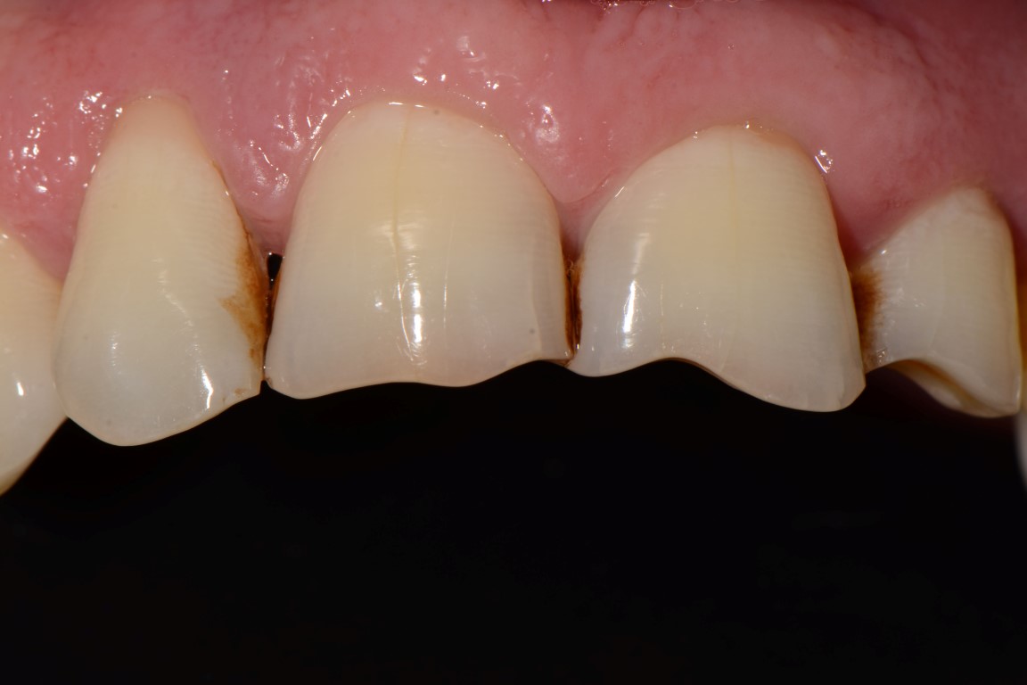 White Filling Example Before