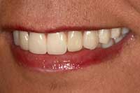 Dental Implant Example After