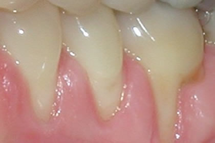 Gingival Grafting Example Before
