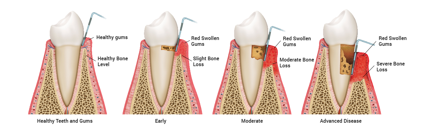 Periodontics Bexleyheath Stages of gum disease